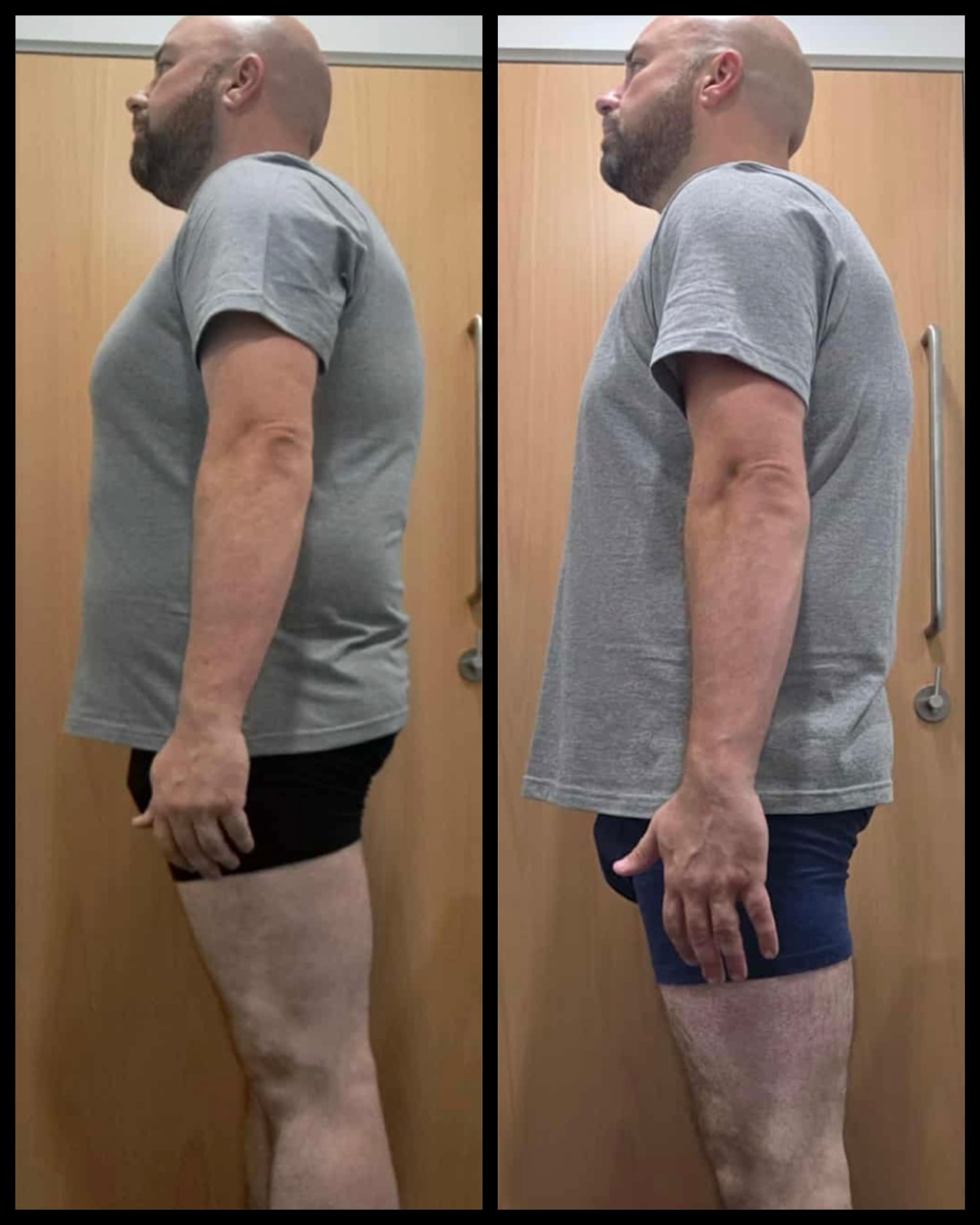 RBT member side view transformation before and after